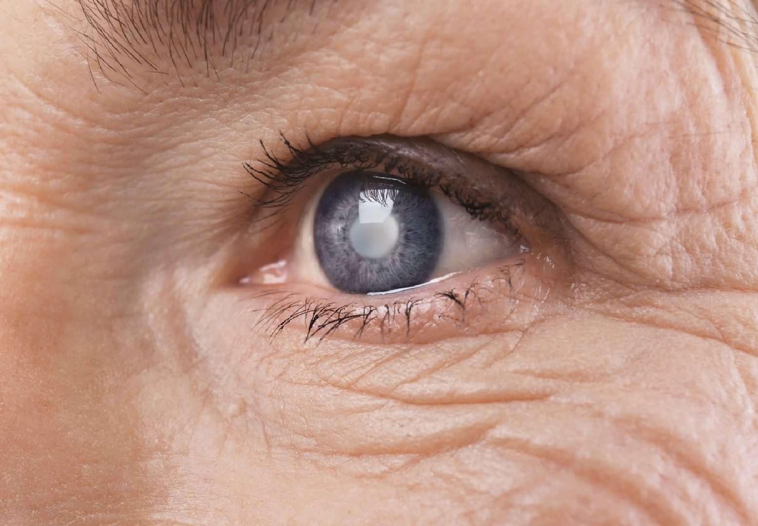 Cataract Surgery - Getting Rid Of The Mist From The Cataract