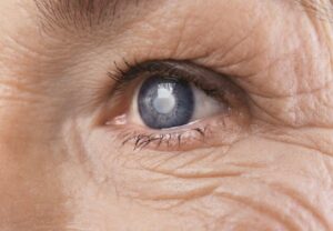 What to Expect During Cataract Surgery