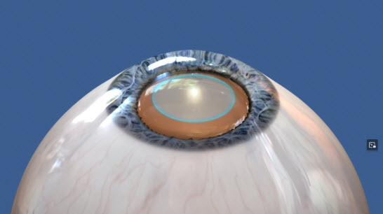 Sussex Eye Laser Clinic Refractive Lens Exchange