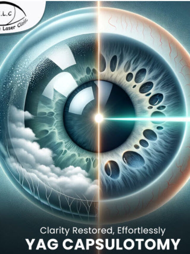 YAG Laser Capsulotomy for Enhanced Vision