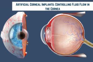 How Artificial Corneal Implants Control Edema and Improve Vision: The Challenge of Fluid Regulation