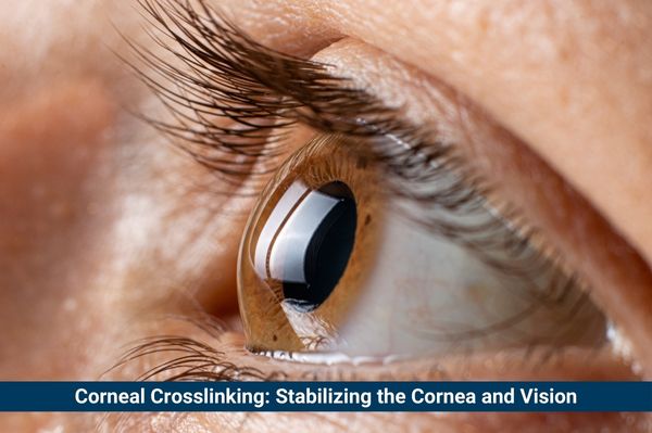 Corneal Collagen Crosslinking: Stabilizing the Cornea & Vision